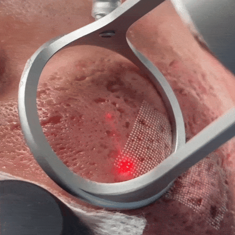 Laser scar treatment close-up